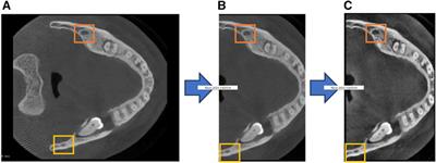 Automatic segmentation of mandibular canal using transformer based neural networks